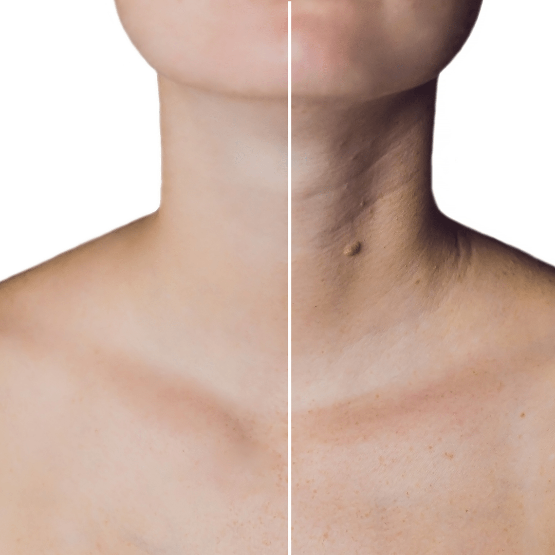 Botox In Neck
