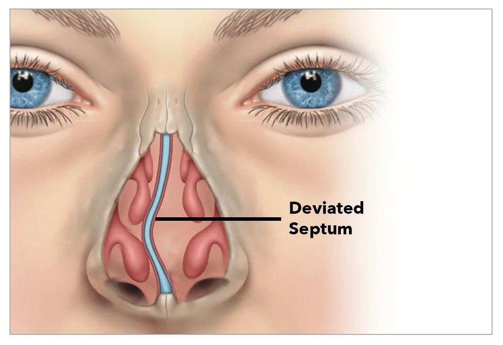 Deviated Septum Surgery