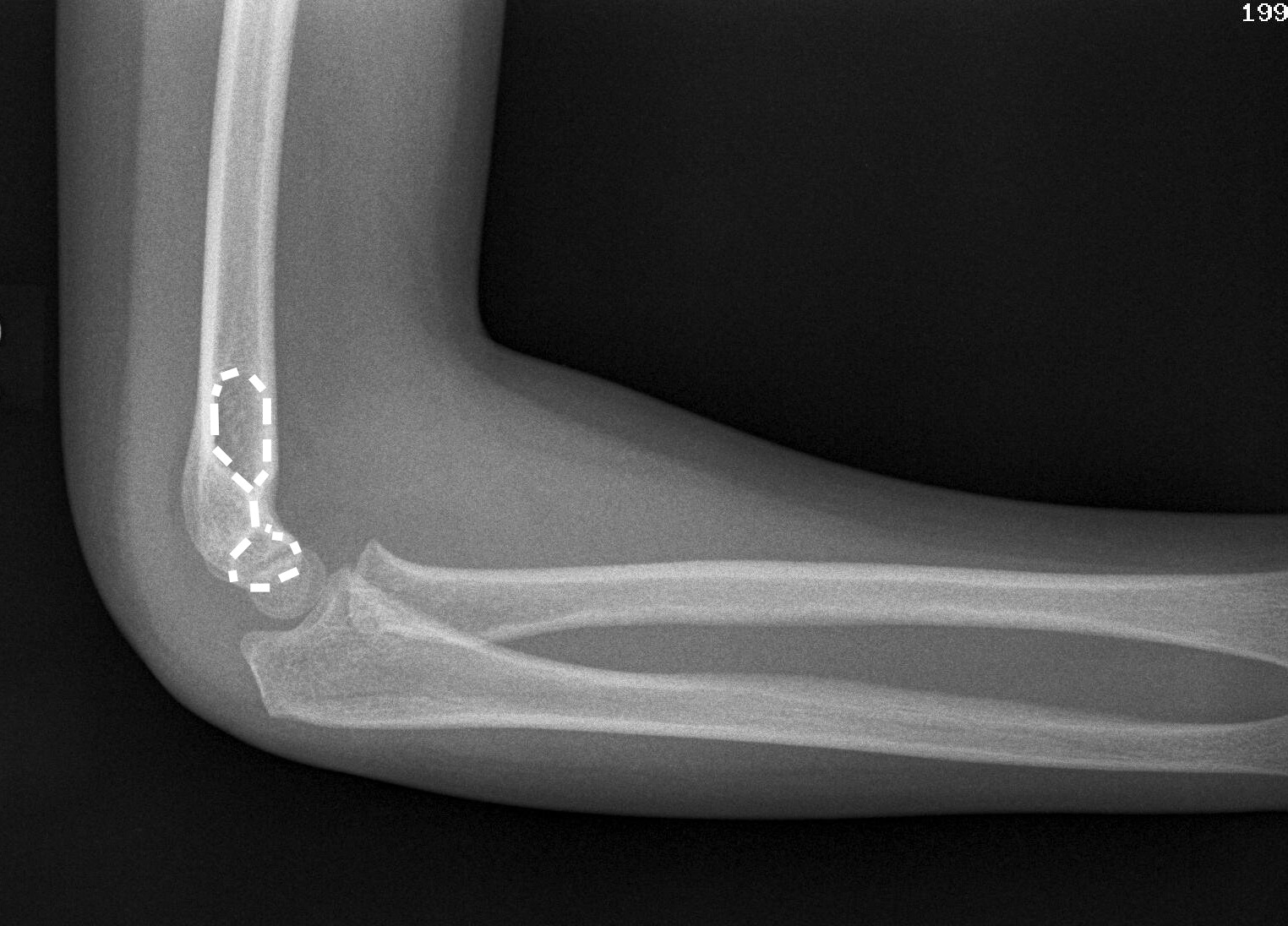 Elbow XRays Don't the Bubbles