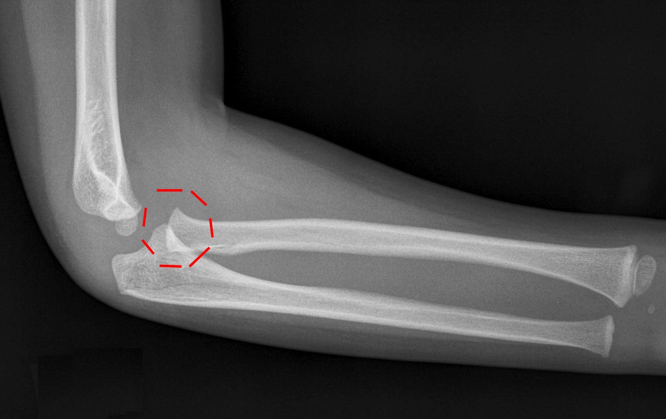 Elbow XRays