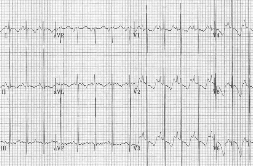 Just another bronchiolitis?