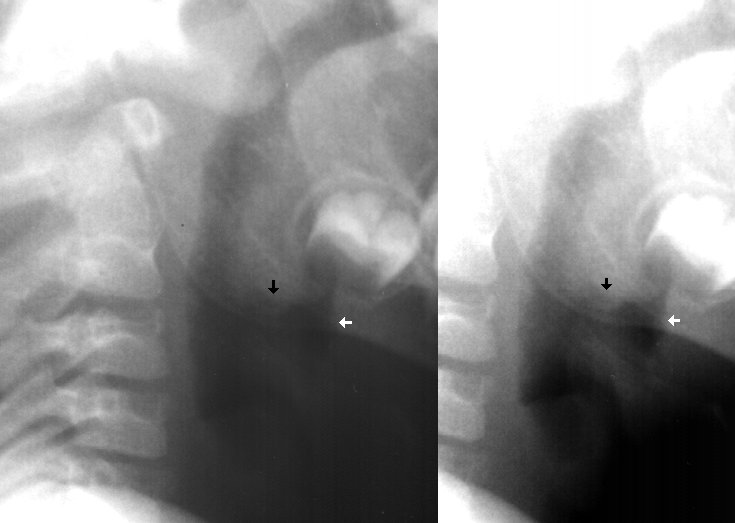 How can we rule out epiglottitis?