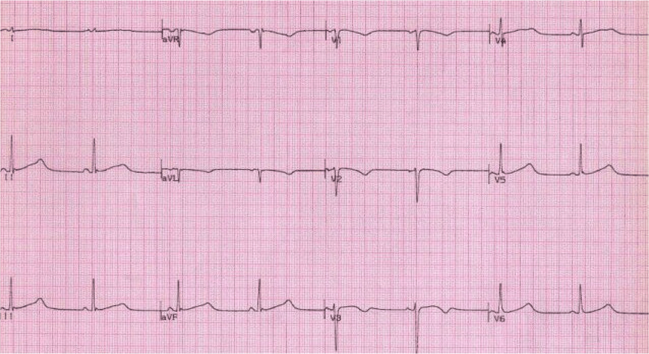 Syncope ECGs