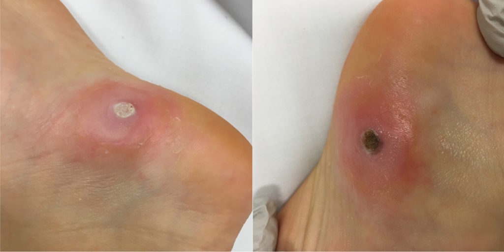 Stages Of Plantar Wart Removal Using Salicylic Acid Bruin Blog