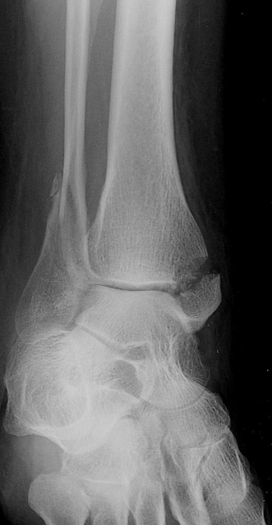 Ankle xrays Don't the Bubbles
