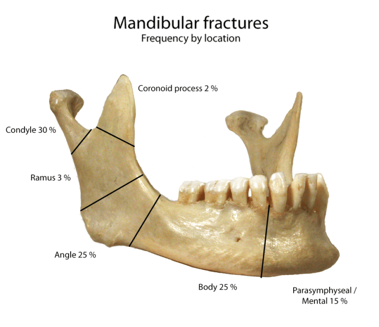 Mandible xrays