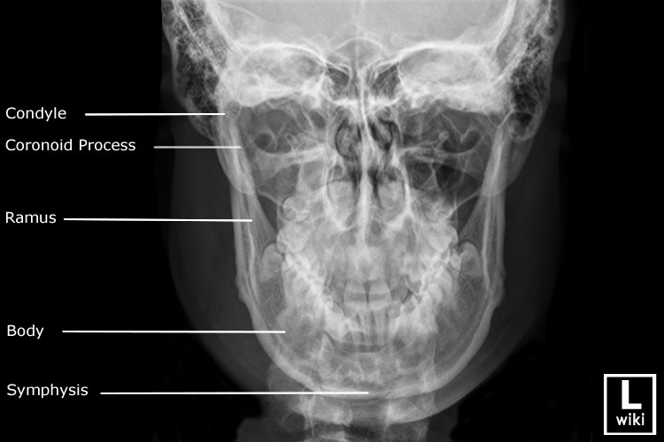 Mandible xrays