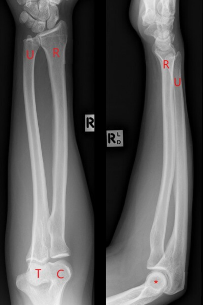 Ulna Hairline Fracture