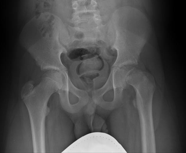 The Limping Child Module