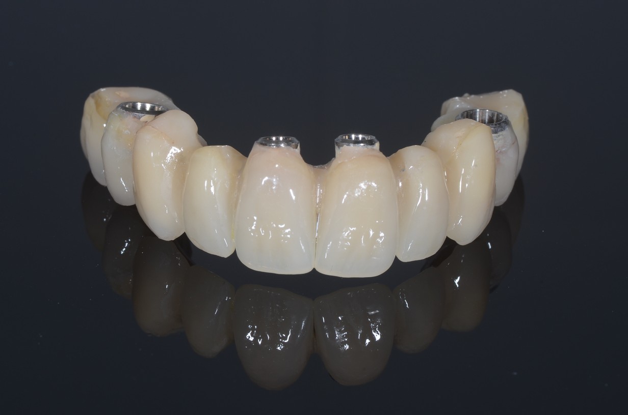 Impressive Dental Implant Before and Afters Dorset Dental Implants