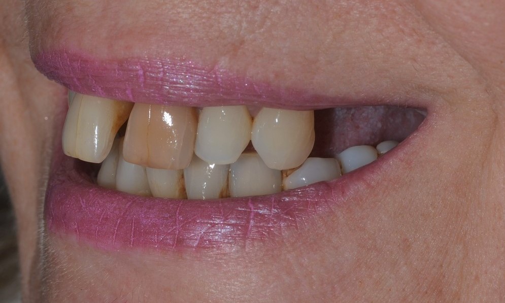 Impressive Dental Implant Before and Afters Dorset Dental Implants