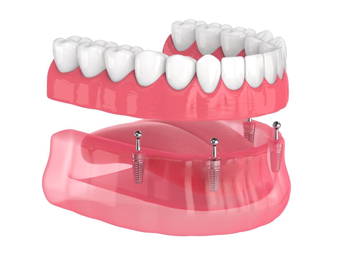 Palateless Dentures to Replace Regular Dentures DDI (Dorset)