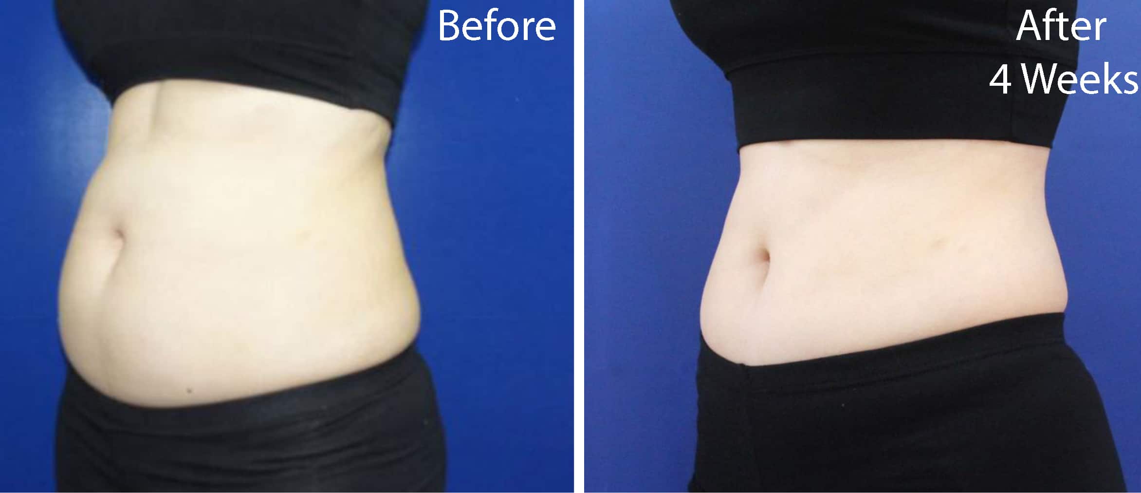 Body Contouring (LIPOcel) Dothan Weight Loss