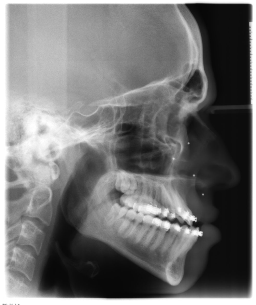 Day 68 Jaw Surgery XRays Double Jaw Surgery