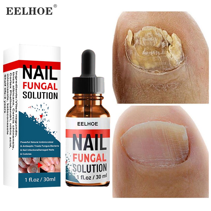 Jual EELHOE Nail Repair Serum Jamur Perawatan Kuku / Obat Penghilang Jamur Kuku / Vitamin Kuku
