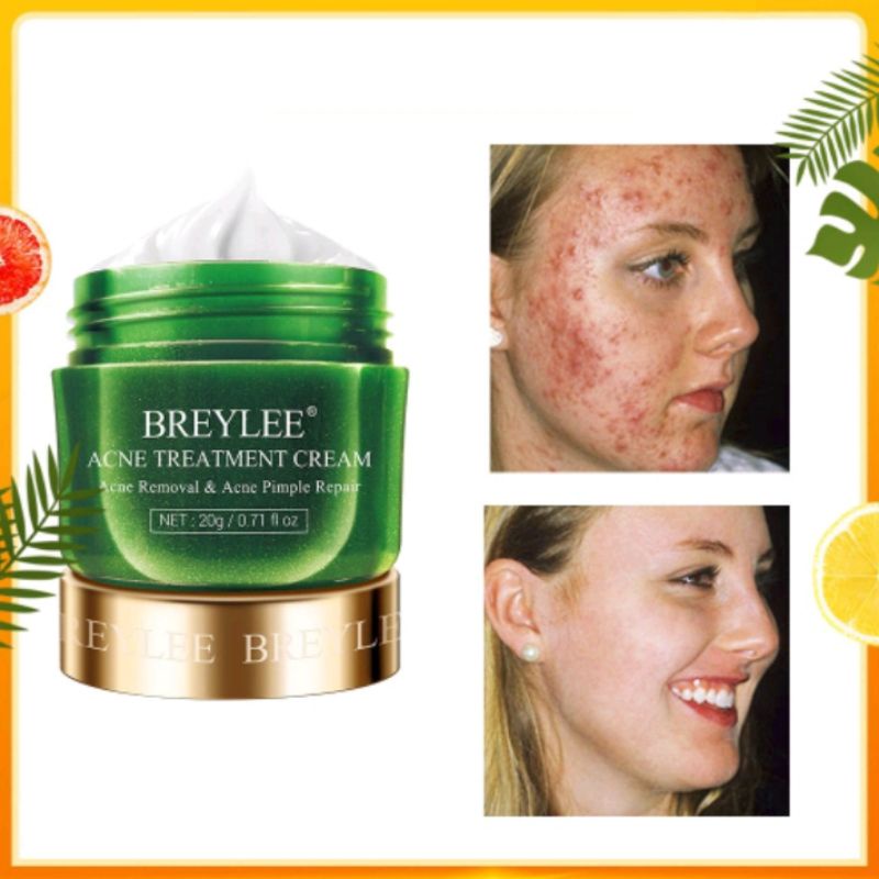 Jual Breylee Acne Treatment Cream Shopee Indonesia