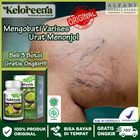 Jual Obat herbal menghilangkan Varises di kaki Urat menonjol di Betis