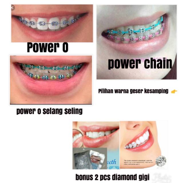 Jual [BISA COD] Behel Lepas pasang POWER O dan POWERCHAIN / behel