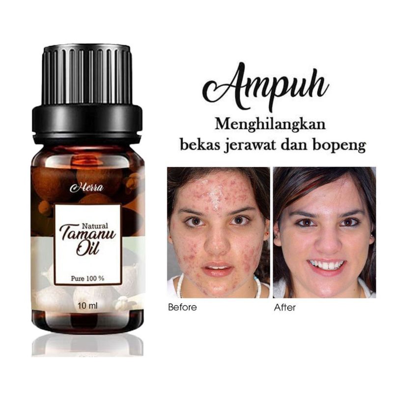 Jual Tamanu Oil 10 Ml Bantu Hilangkan Bekas Jerawat dan Bopeng