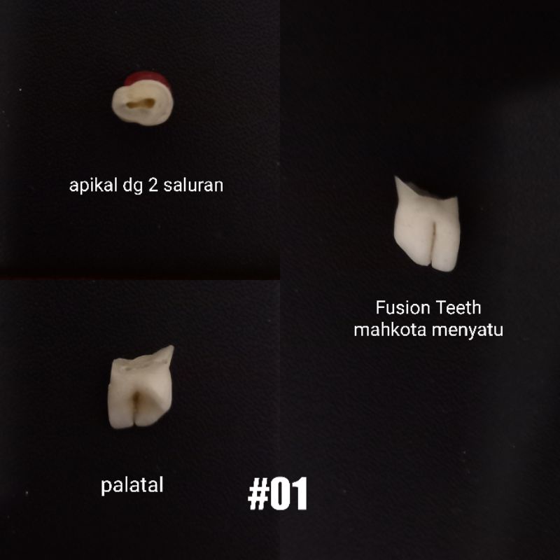 Jual Gigi Anak dengan kelainan Fusion teeth Gigi fusi Gigi conus