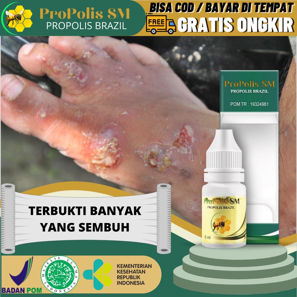 Jual Obat Oles Budug, Borok, Tetes Gatal Bernanah, Herpes, Obat Budug