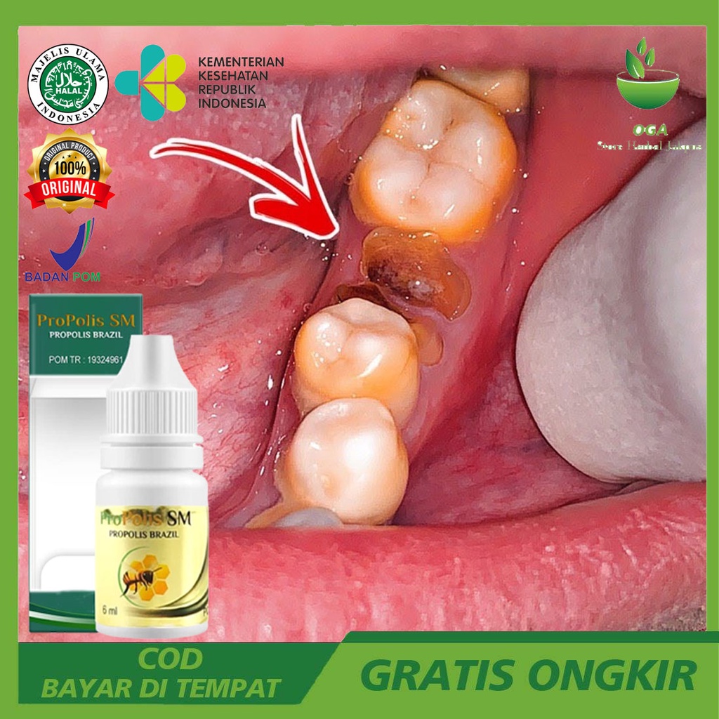 Perforated Tooth Root Medicine Tooth Pain Mouthwash Natural Tooth