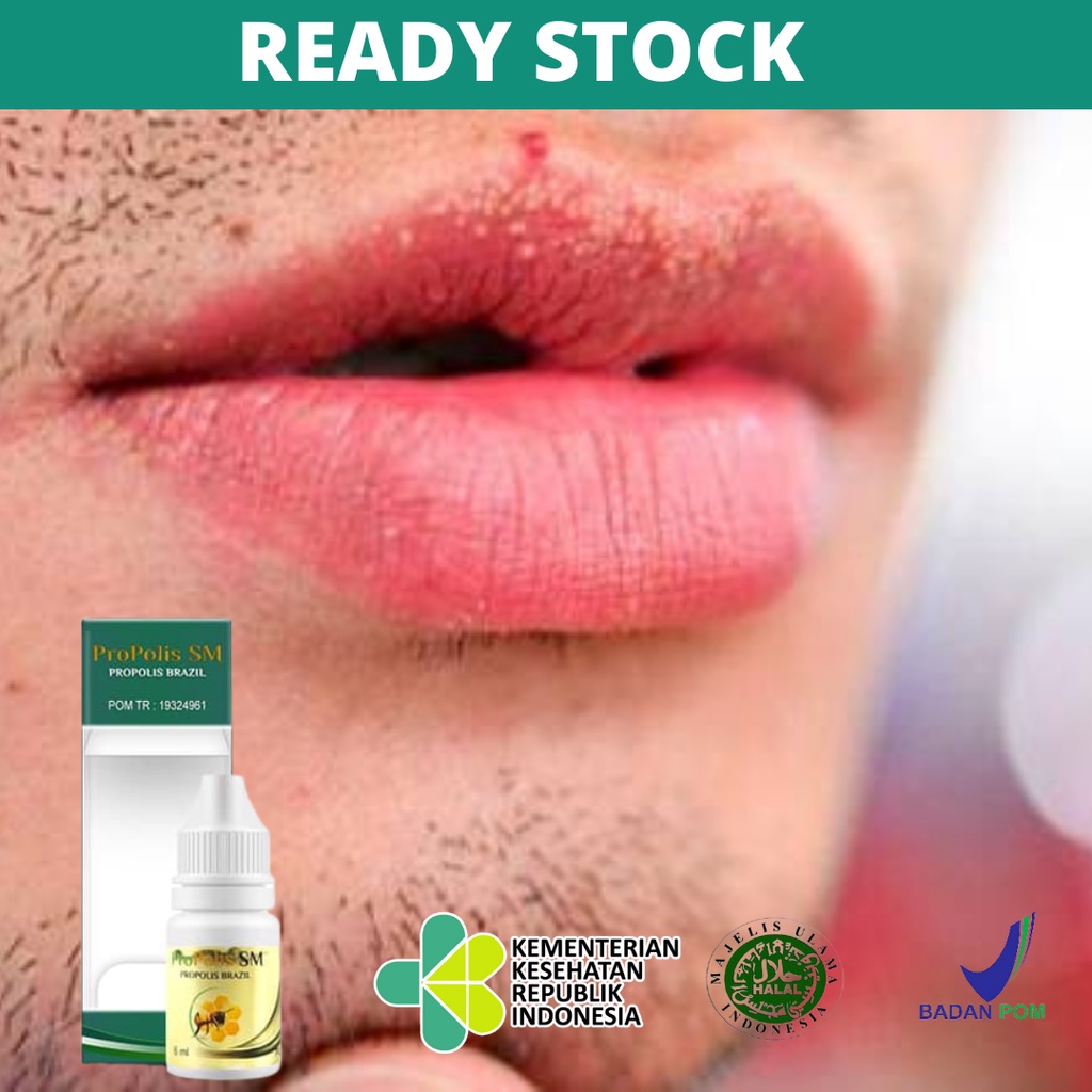 PUTIH Medication For Removing White Spots On The Lips, Medicine For