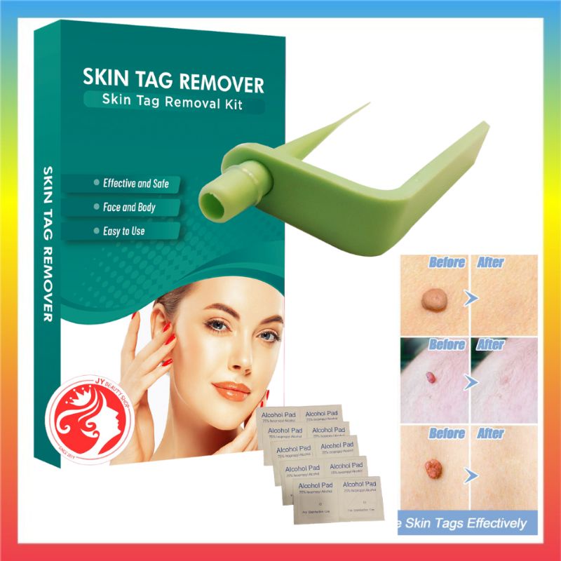 Medical Skin Tag Removal Kit Wart Remover Skin Tag Removar Buang Ketuat