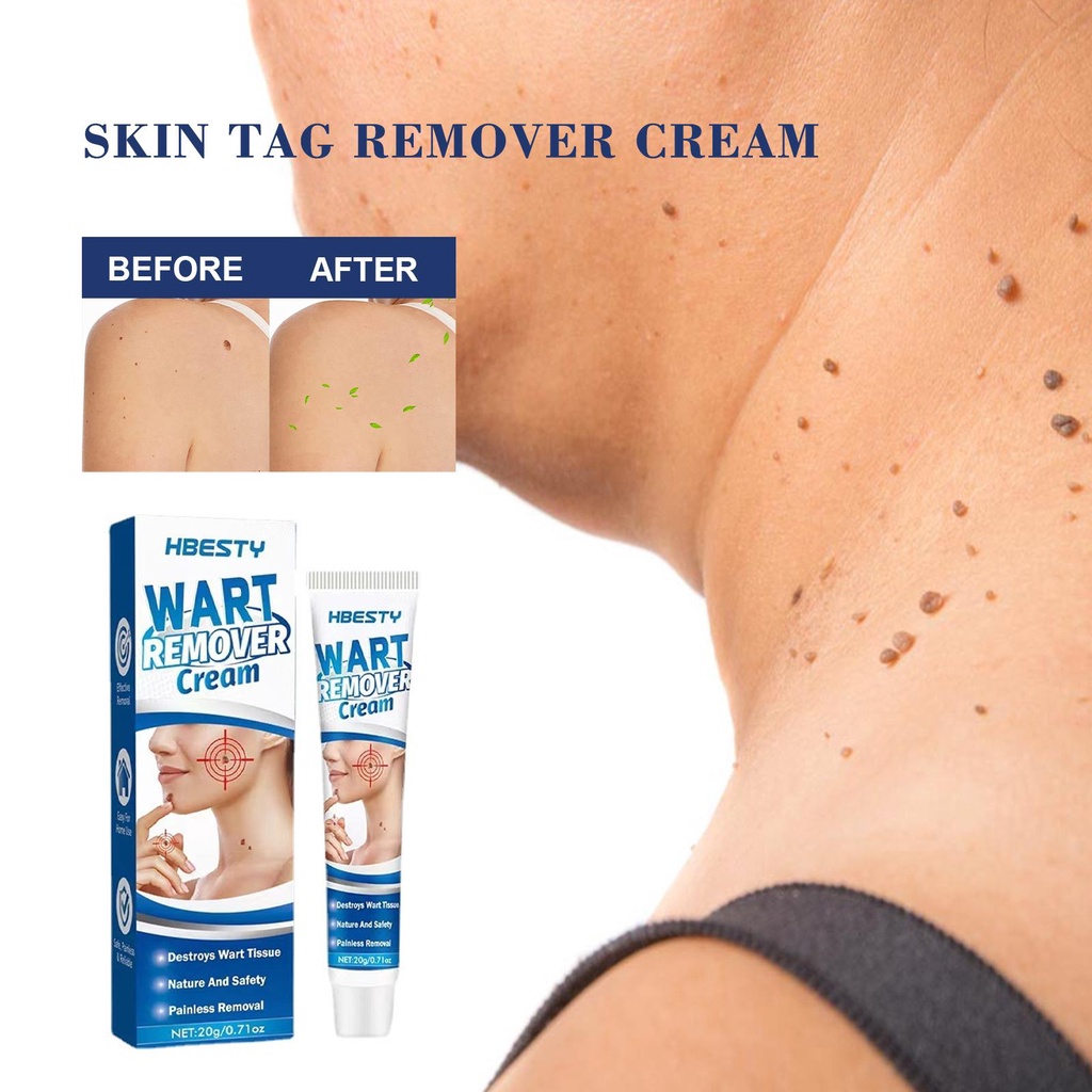 Face Wart Tag Treatment Removal Essential Skin Tag Remover Cream