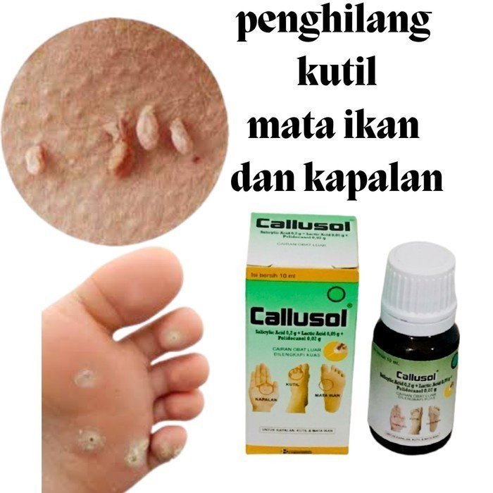 MATA The Newest callusol Wart Medicine herbal Medicine For Removing