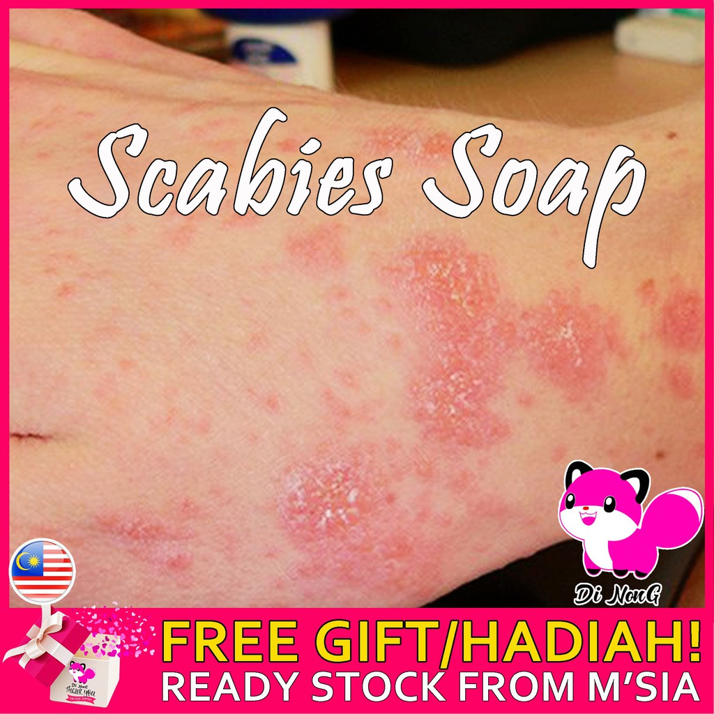 Gatal Antifungal Antibacterial Scabies Soap Psoriasis Eczema Sabun