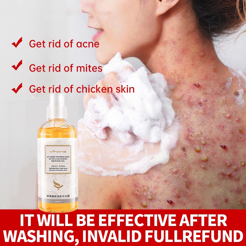Acne Shower Gel Mites Removal Itchy Skin Antibacterial Shower Gel