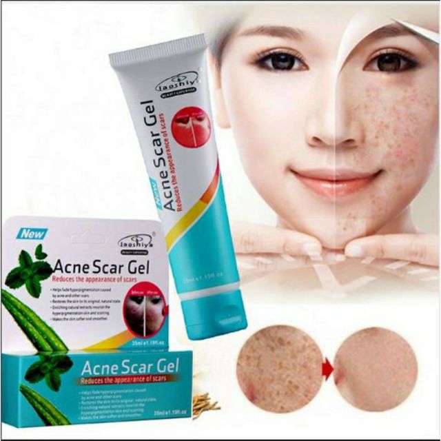 Aloe Vera Acne Scar Gel, Acne Scar Treatment, Acne Pimple Spot Scar Removal Gel Shopee Malaysia