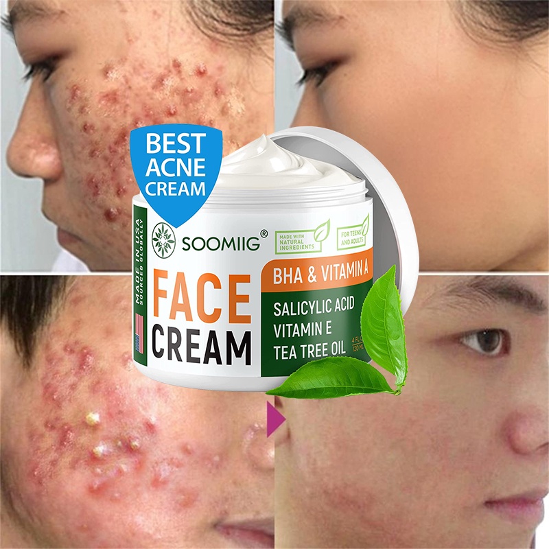 50g Acne Removal Cream Herbal Efficacy Stains Oil Control Skin Care