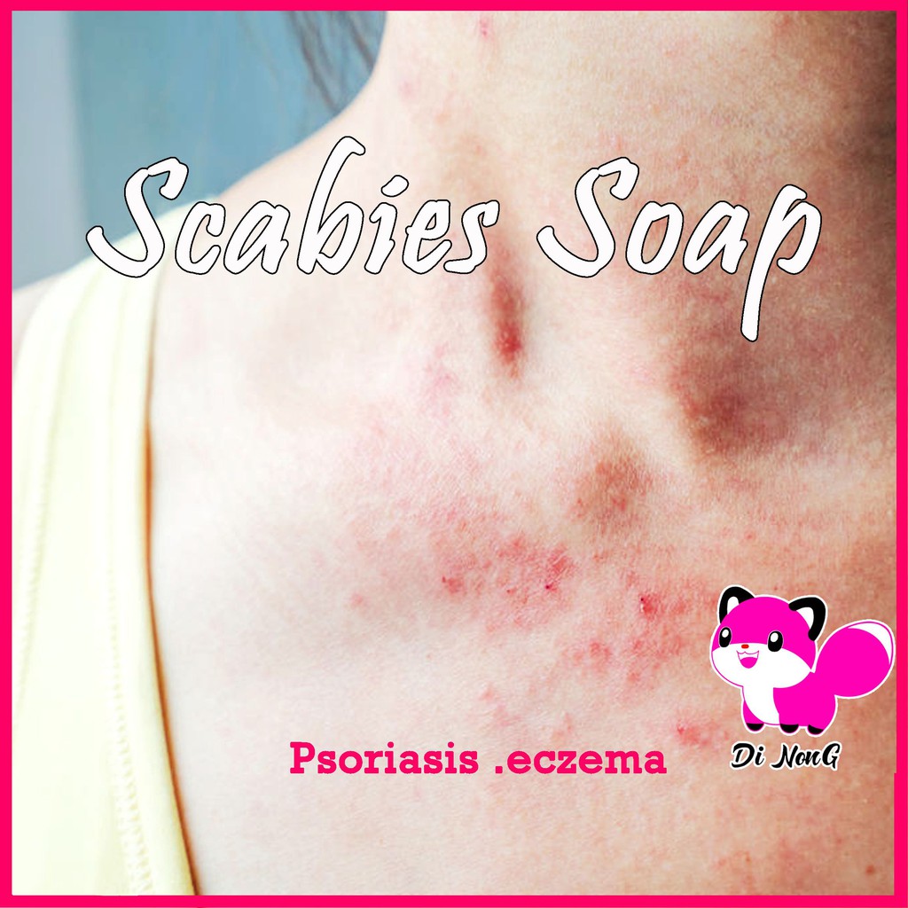 Gatal Antifungal Antibacterial Scabies Soap Shopee Malaysia
