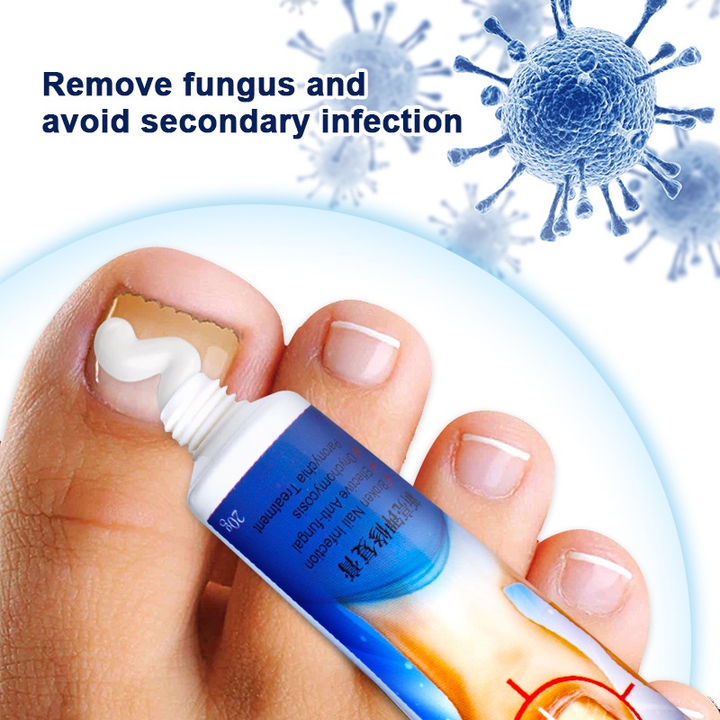 Nail Fungus Treatment Nail Care Cream Nail Repair Cream Onychomycosis Toenail Fungus Cream