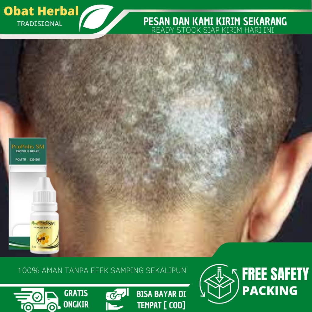 Scalp Fungus Medicine, Scalp Medicine, Medication For Scalp Fractures