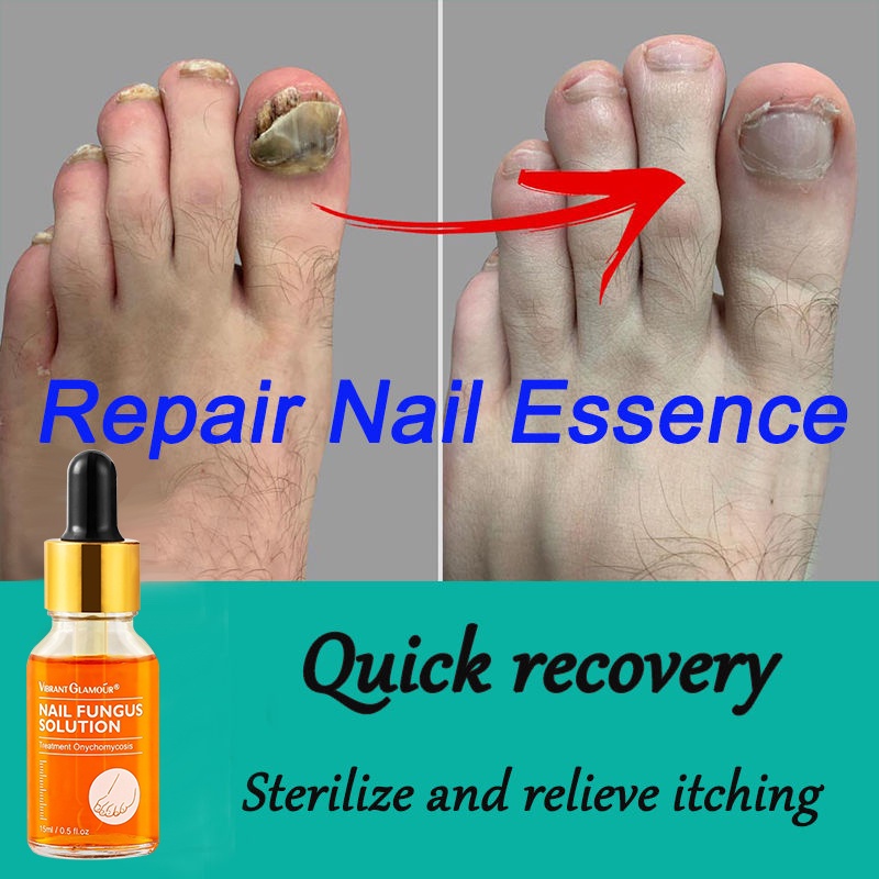 Nail Fungus Treatment Best Nail Repair Stop Fungal Growth Effective