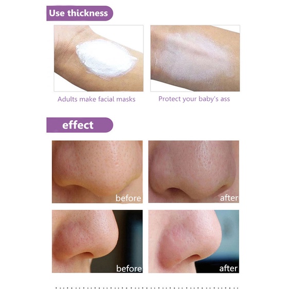 Sudocrem original curing cream diaper rash hemorrhoids psoriasis ointment psoriasis dermatitis