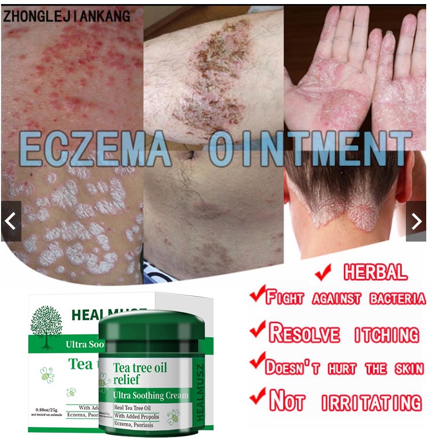 Clobetasol ointment Antiitch cream dermatitis eczema cream itchy skin