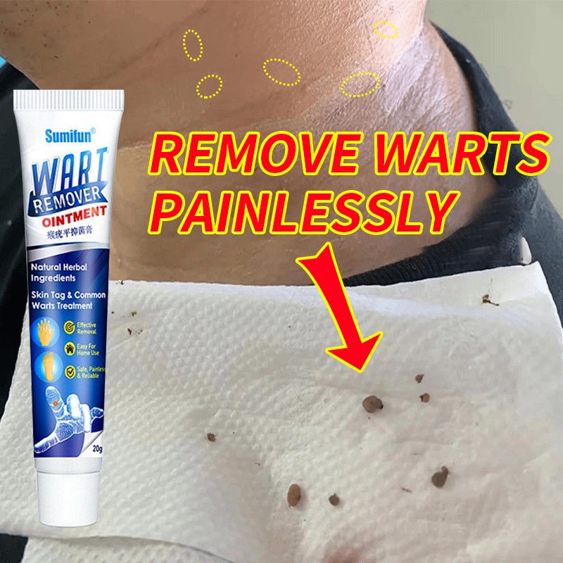 Warts Remover Cream skin Repair Plantar Warts Removal Body Warts