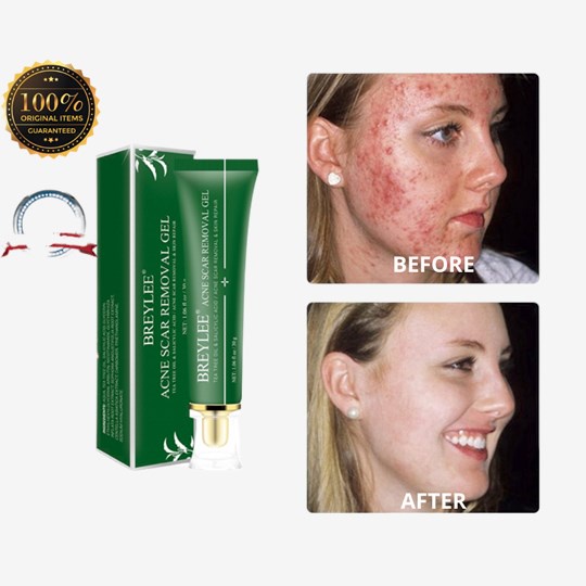 100 Original BREYLEE Acne Treatment Cream Anti Acne Face Gel Pimple