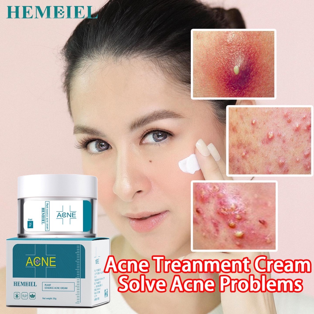 HEMEIEL Acne Remover/Benzoyl Peroxide/Pimple Marks Remover Facial