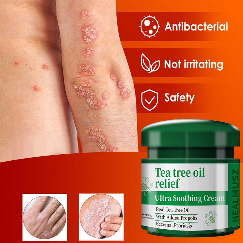 ஐitching cream dermatitis eczema cream itchy skin remedy psoriasis