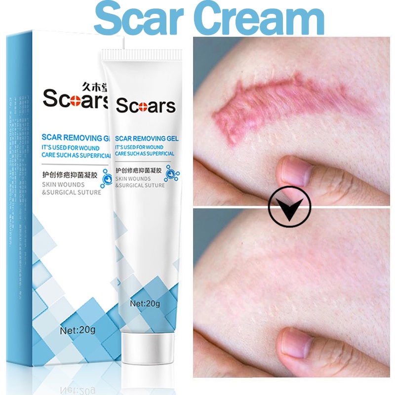Scar Remover Repair Scar Cream Effective remove Strech Mark Acne Treatment Whitening fixscar 20g