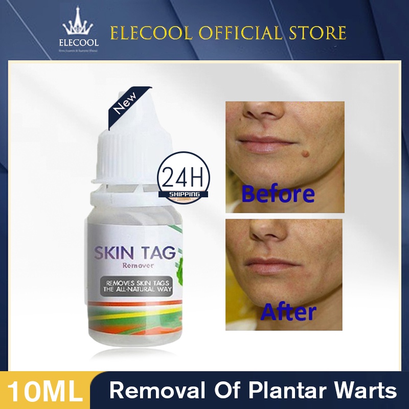 10ml Skin Tag Remover Chinese Medicine Treatment Skin Warts Removal