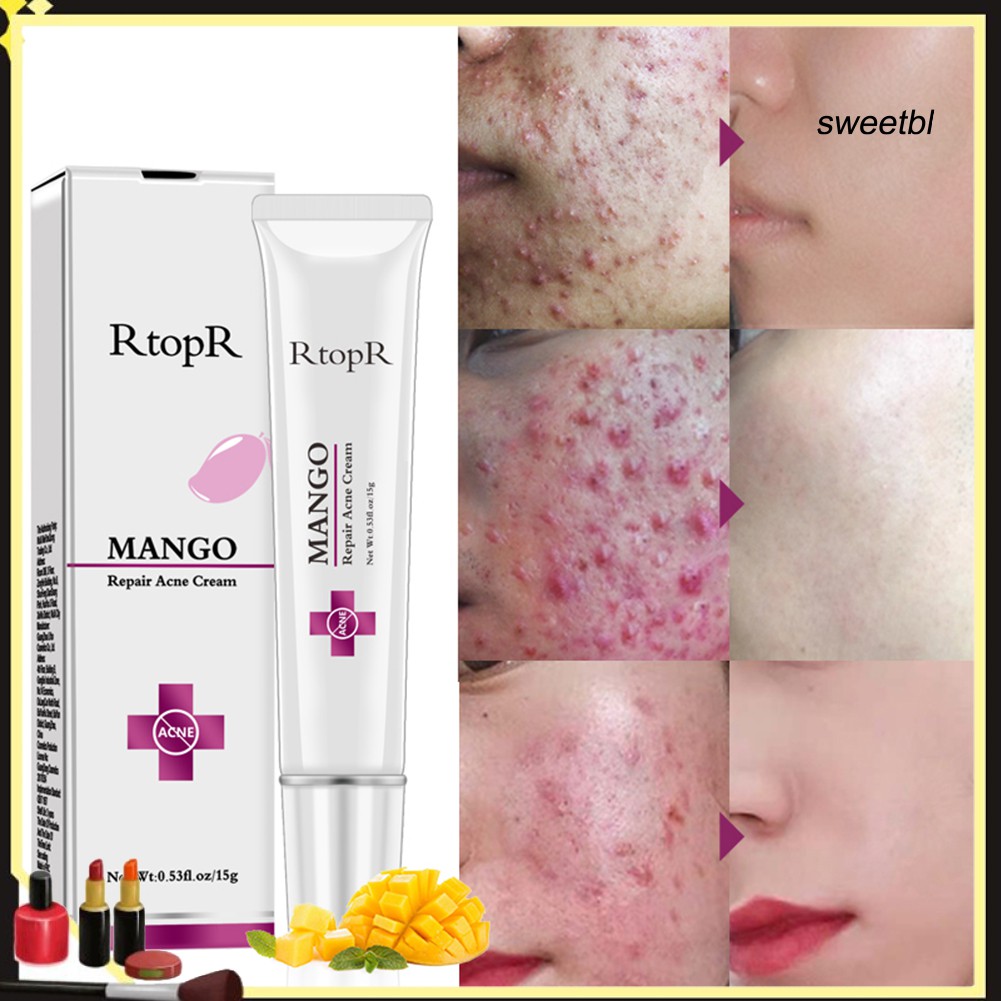 SWEN_RtopR Mango Acne Remove Cream Anti Spots Scar Blackhead Shrink