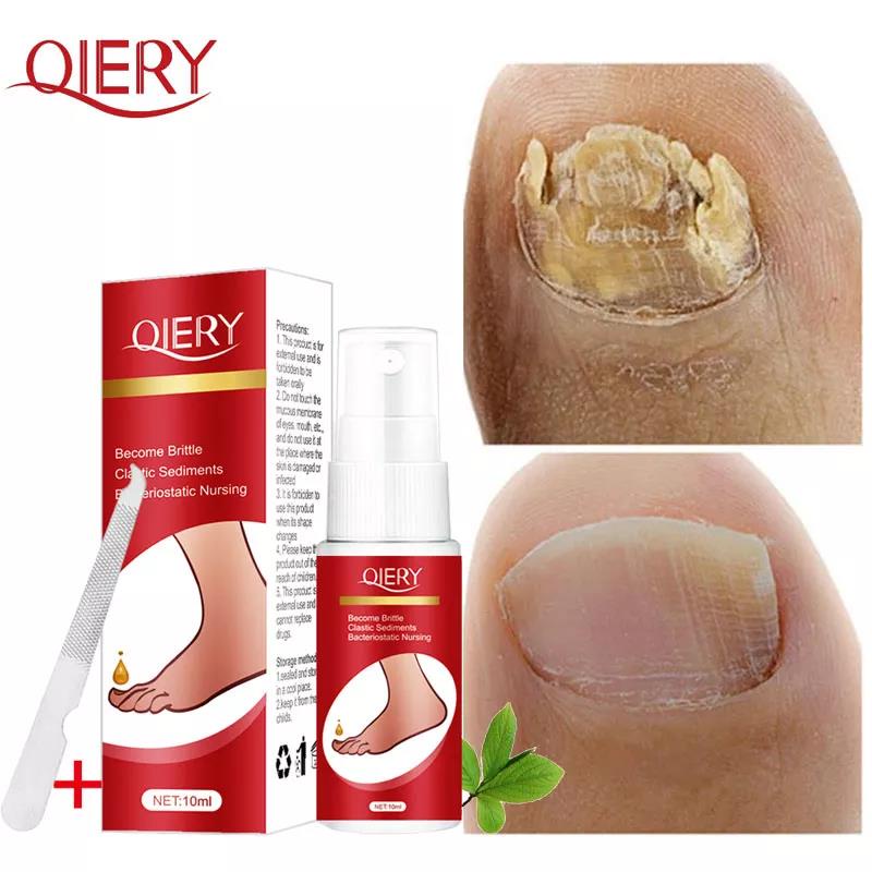 Nail Fungal Treatment Essence Feet Care Nail Fungus Repair Gel Serum