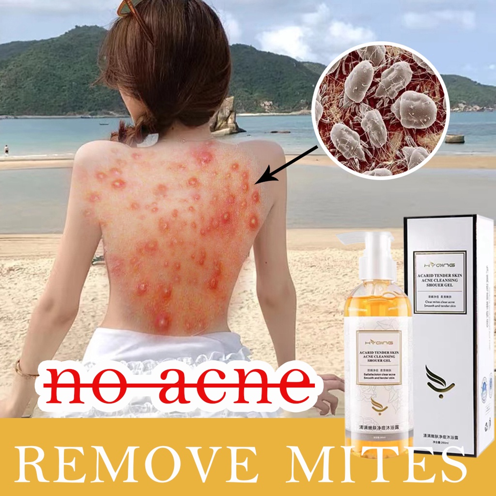 2022Whitening body wash Acne body wash Shower Gel For Dry Acne Itchy