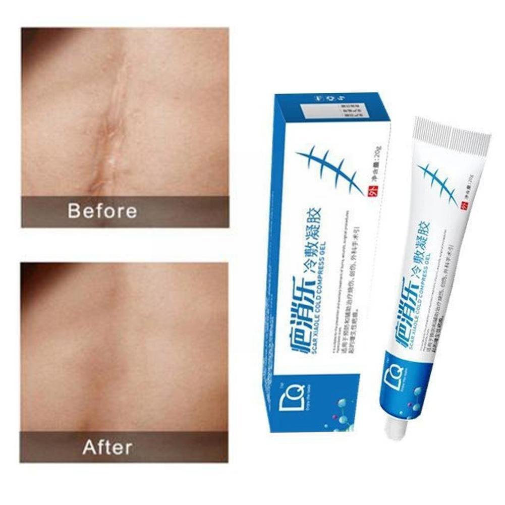 Tanggalin ang peklat Effective Ae Scar Removal Cream Shrink Pores
